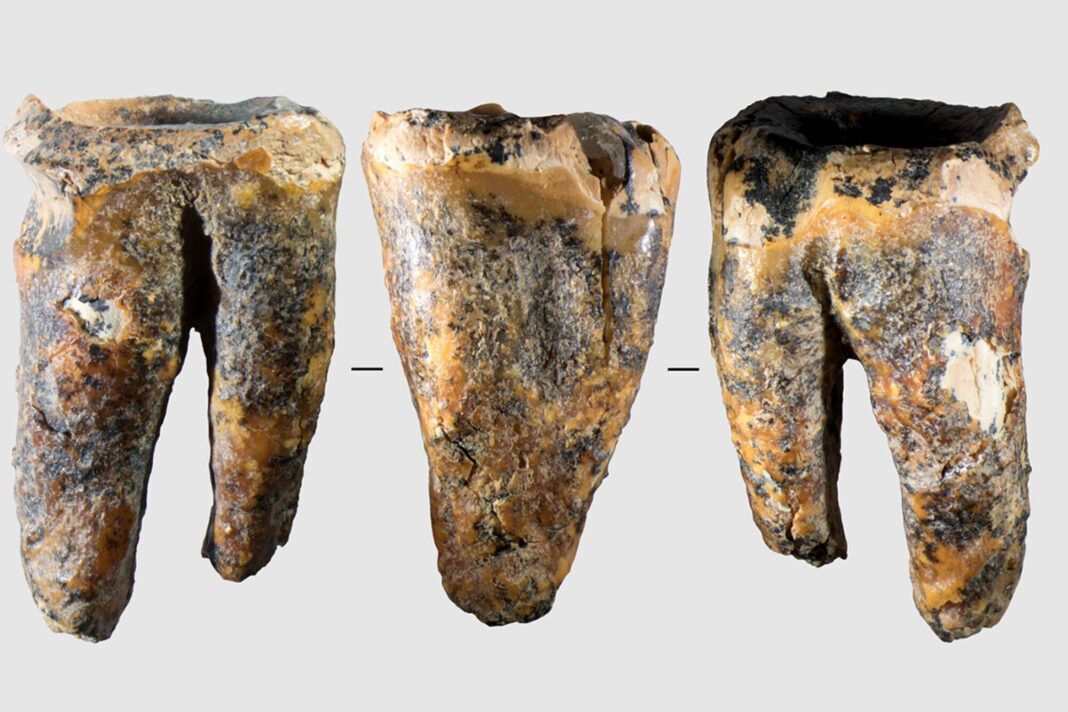 Molar neandertal Chagyrskaya 64 con evidencia de tratamiento de caries