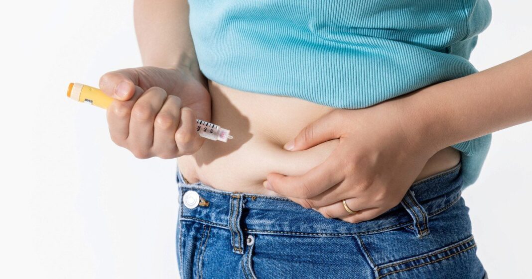 Procedimiento de gastroplastia endoscópica en manga para tratar obesidad