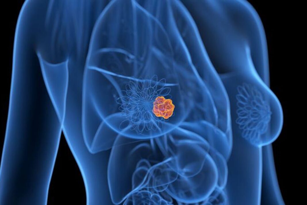 Investigadores argentinos detectan mayor rigidez arterial en mujeres que superaron cáncer de mama